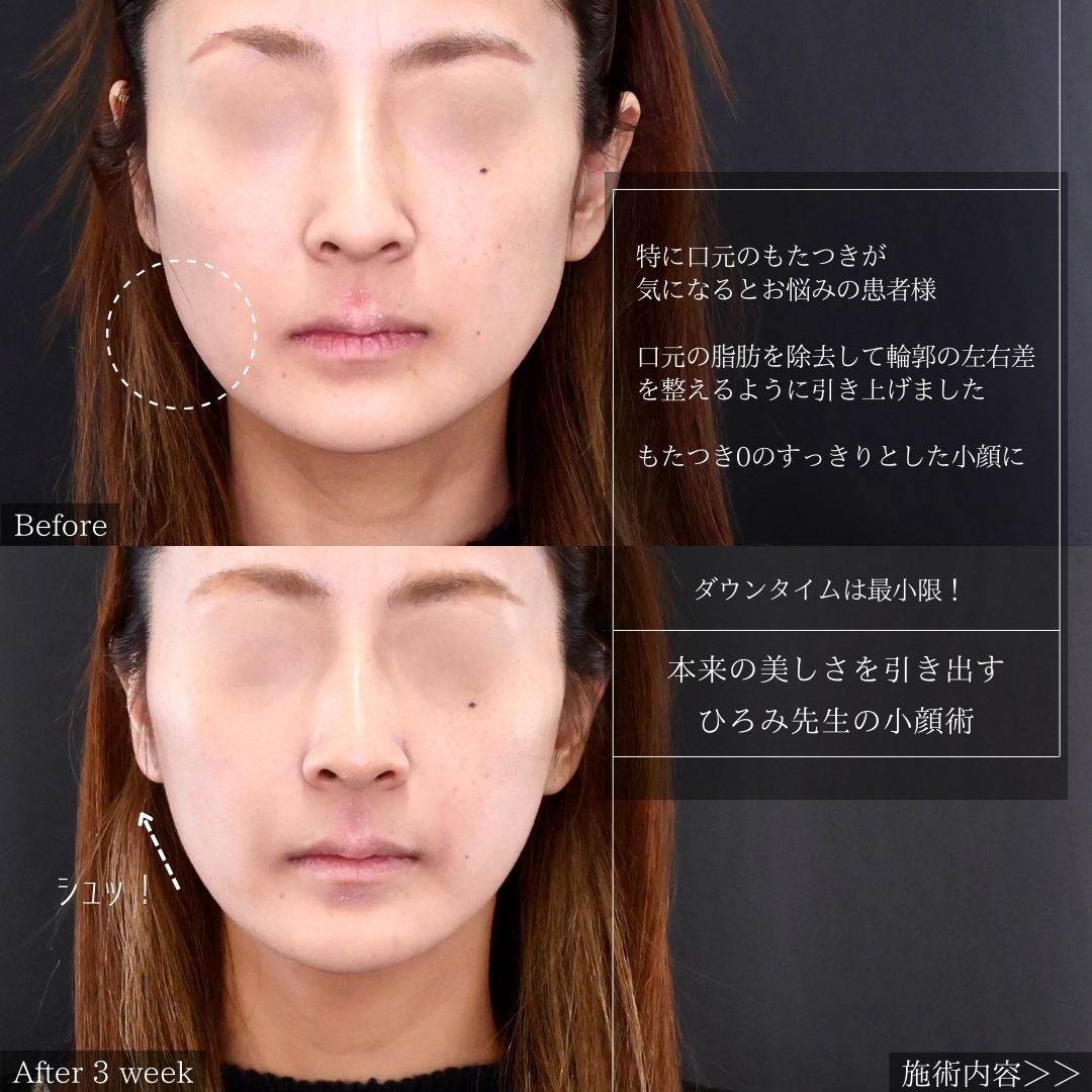 TAC式 ツヤ肌コラーゲンリフト®/ジョールファット除去/ほうれい線のヒアルロン酸注射の症例写真 施術前後 