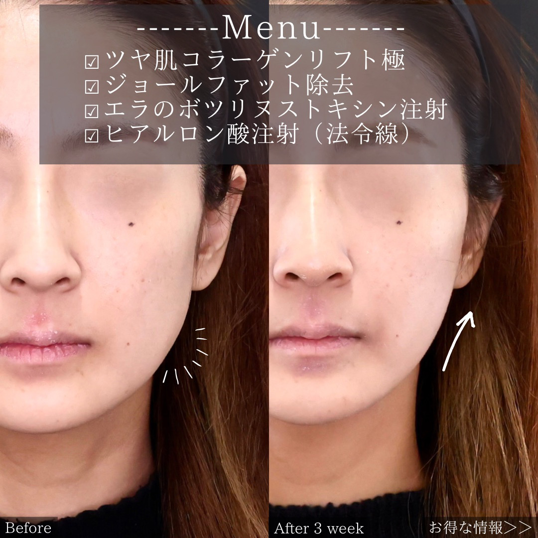 TAC式 ツヤ肌コラーゲンリフト®/ジョールファット除去/ほうれい線のヒアルロン酸注射の症例写真 施術前後 