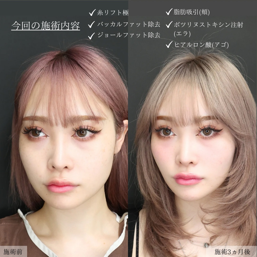 TAC式 ツヤ肌コラーゲンリフト®/バッカルファット除去/ジョールファット除去の症例写真 施術前後 