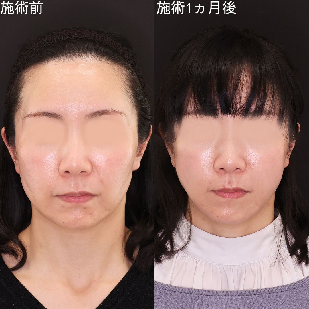 気になる弛みを改善する！50代の若返り小顔術【小顔複合術】