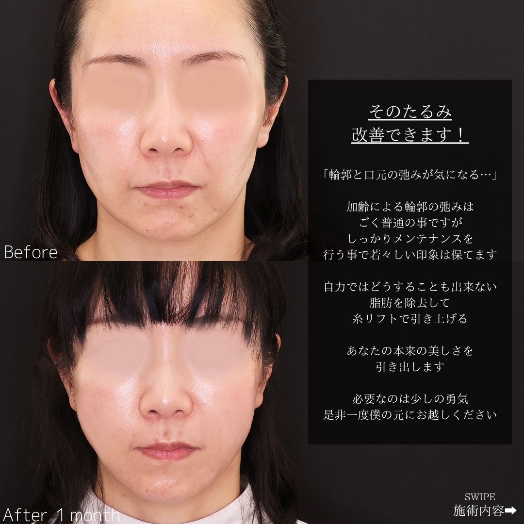TAC式 ツヤ肌コラーゲンリフト®/ジョールファット除去の症例写真 施術前後 