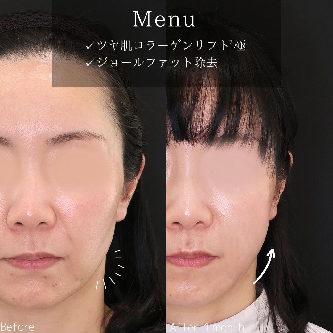 TAC式 ツヤ肌コラーゲンリフト®/ジョールファット除去の症例写真 施術前後 