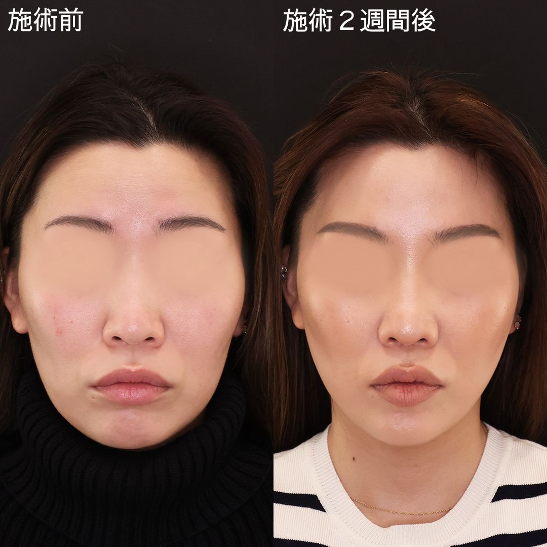 【糸リフト】シュっと美しい輪郭に！即日小顔リフト