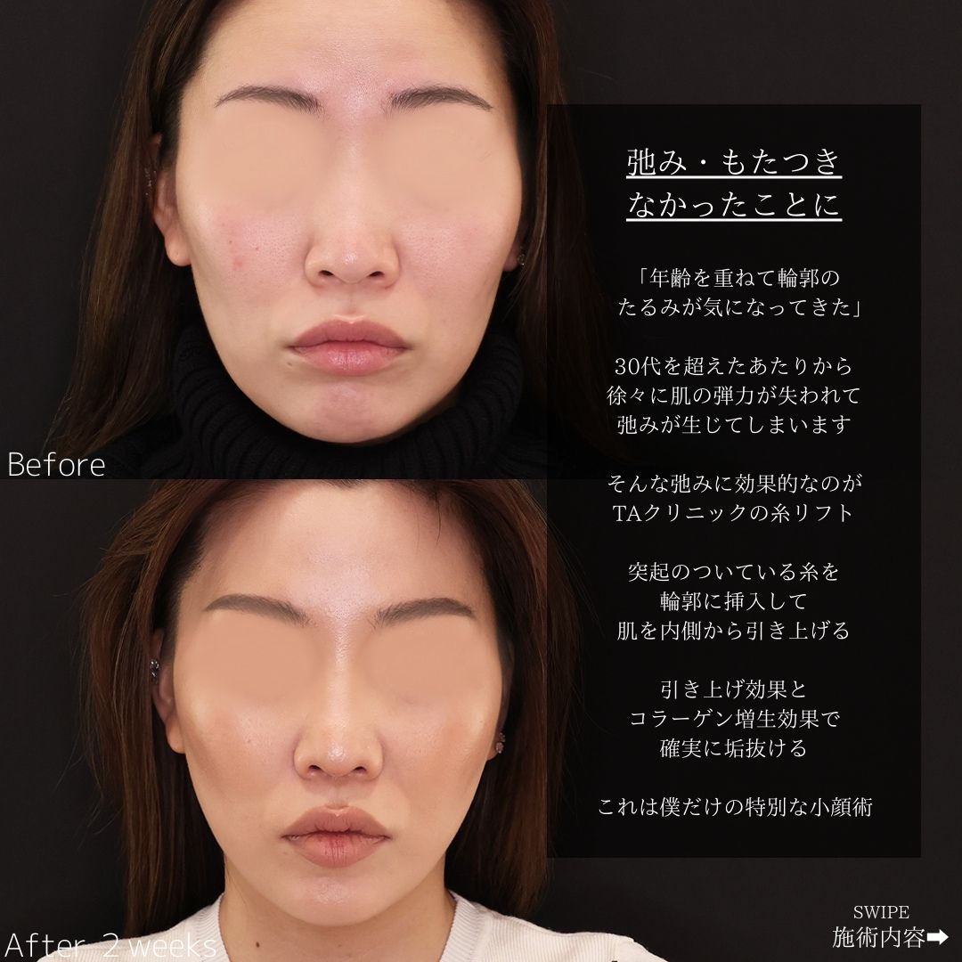 TAC式 ツヤ肌コラーゲンリフト®/ボトックス注射：その他/ヒアルロン酸注射：その他の症例写真 施術前後 