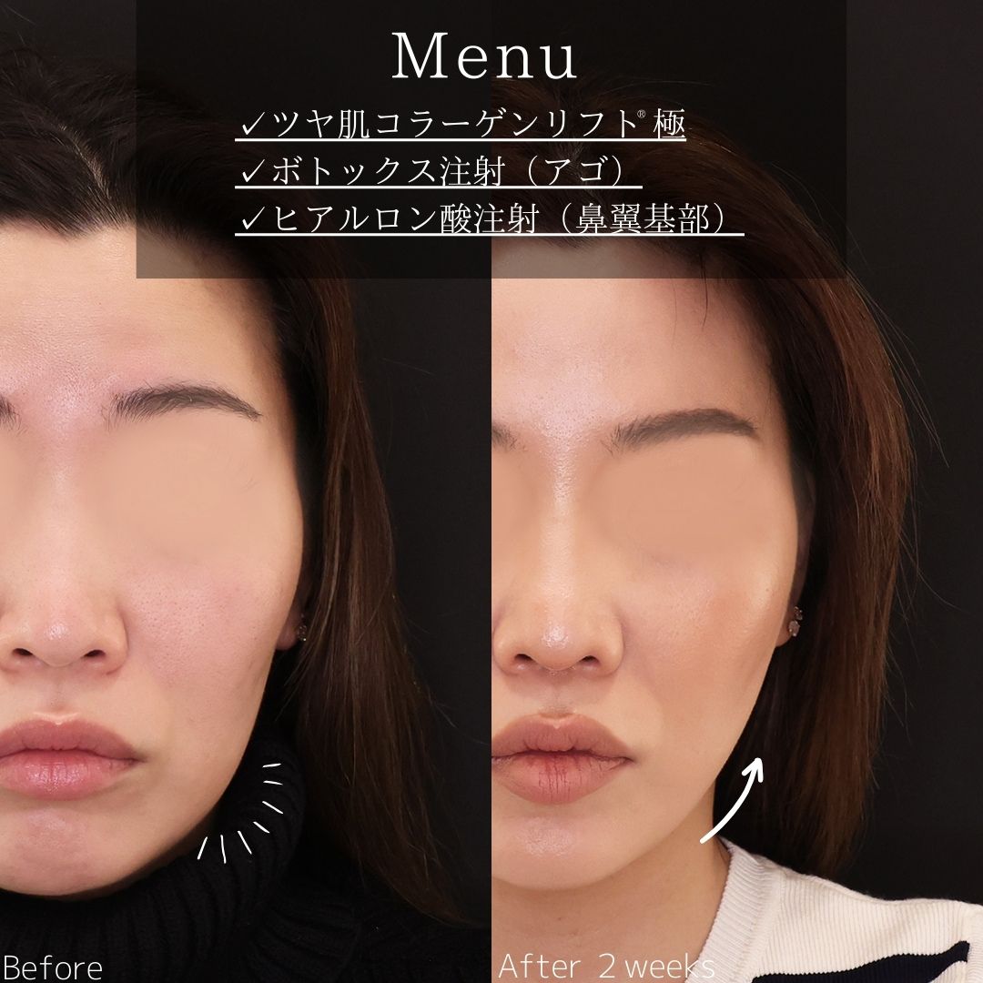 TAC式 ツヤ肌コラーゲンリフト®/ボトックス注射：その他/ヒアルロン酸注射：その他の症例写真 施術前後 