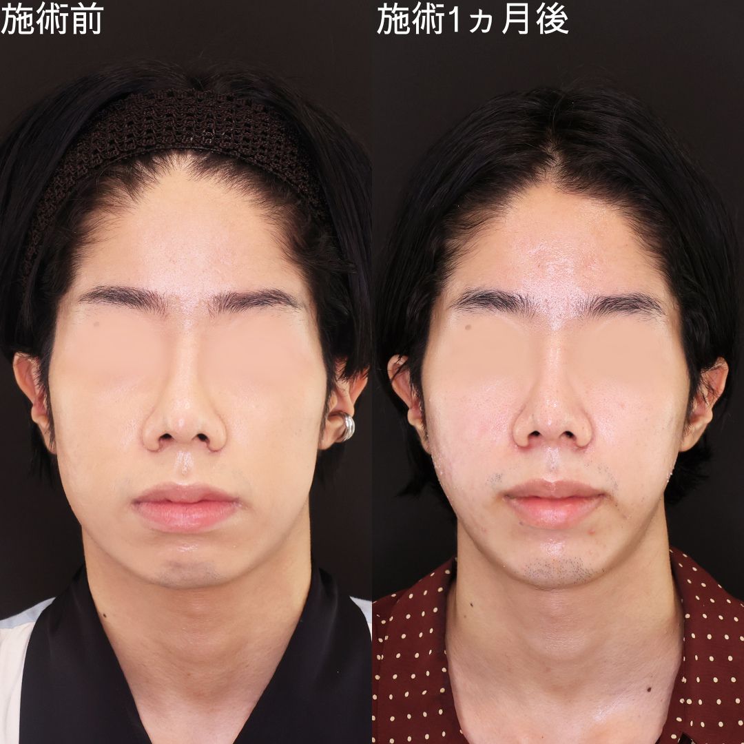 骨切り無しで輪郭洗練 メンズ小顔術【小顔複合施術】