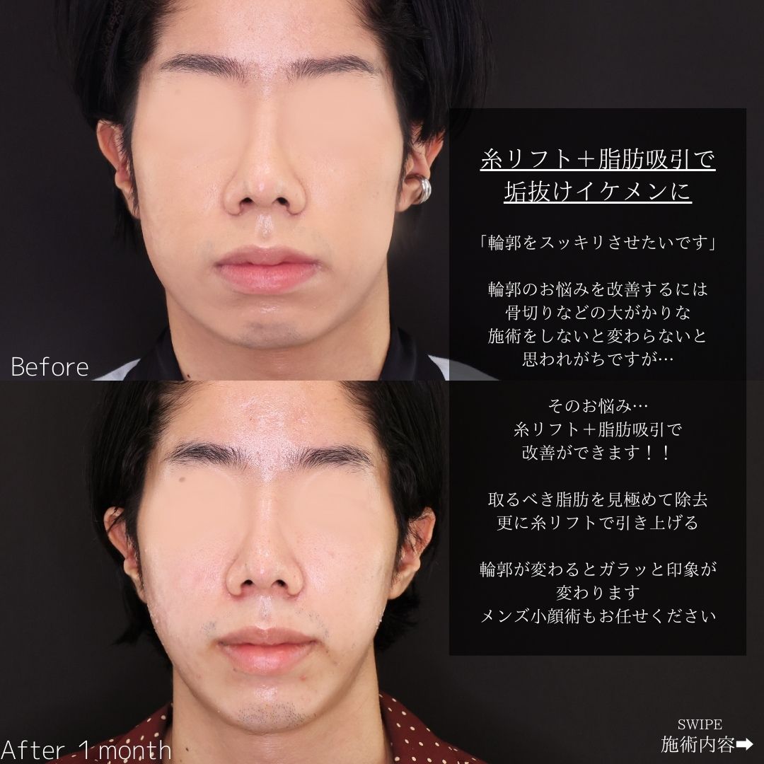 TAC式 ツヤ肌コラーゲンリフト®/ジョールファット除去/バッカルファット除去の症例写真 施術前後 