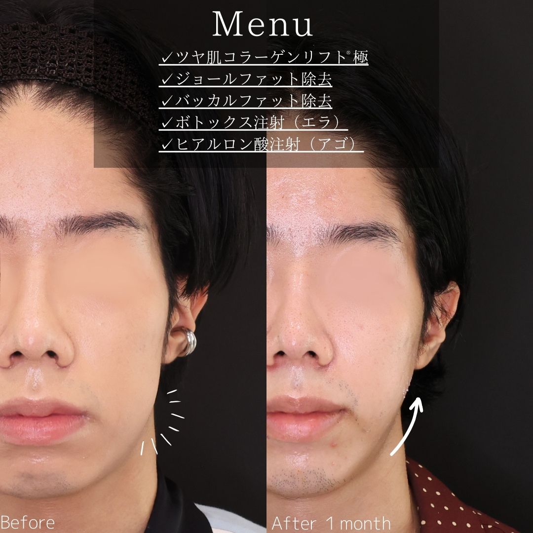 TAC式 ツヤ肌コラーゲンリフト®/ジョールファット除去/バッカルファット除去の症例写真 施術前後 