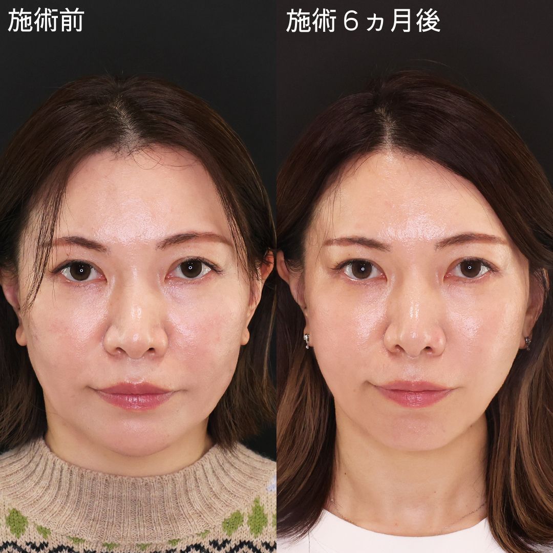 切らず削らず輪郭を整える！弛み改善小顔術【糸リフト×脂肪除去】