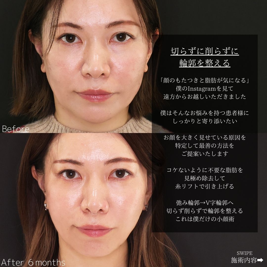 TAC式 ツヤ肌コラーゲンリフト®/ジョールファット除去/Lラインファット除去（エラ下脂肪除去）の症例写真 施術前後 