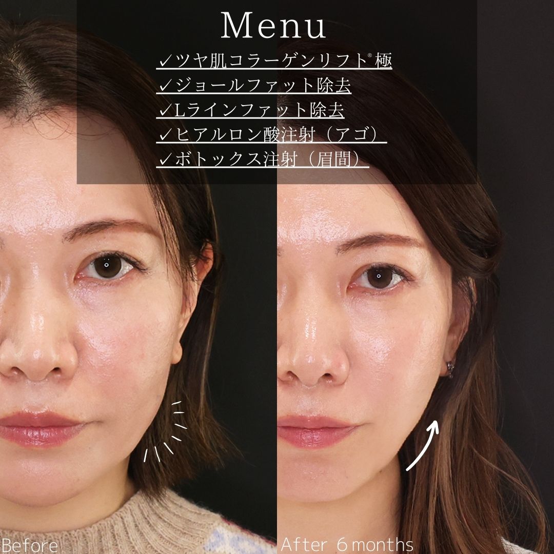 TAC式 ツヤ肌コラーゲンリフト®/ジョールファット除去/Lラインファット除去（エラ下脂肪除去）の症例写真 施術前後 