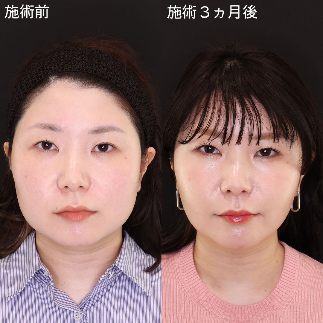 顔のボリュームダウン！圧倒的垢抜け小顔術【小顔複合術】