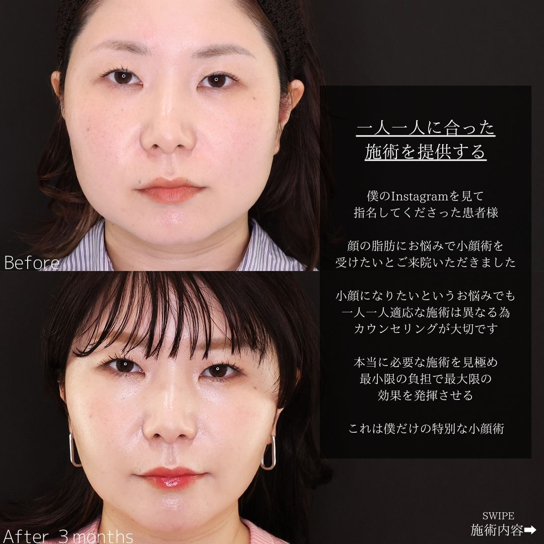 TAC式 ツヤ肌コラーゲンリフト®/バッカルファット除去/ジョールファット除去の症例写真 施術前後 