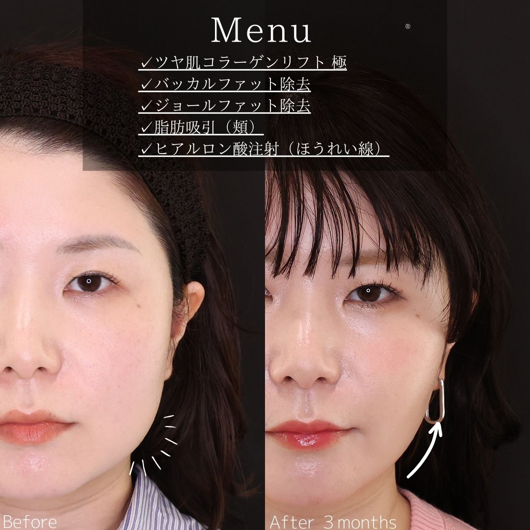 TAC式 ツヤ肌コラーゲンリフト®/バッカルファット除去/ジョールファット除去の症例写真 施術前後 