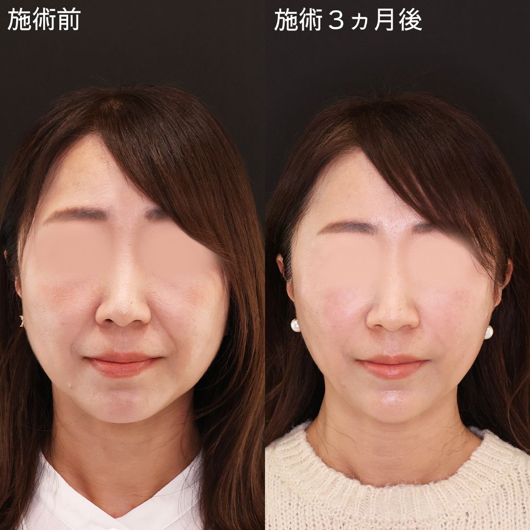 顔の弛みもう悩まない！50代の若返り小顔術【小顔複合術】