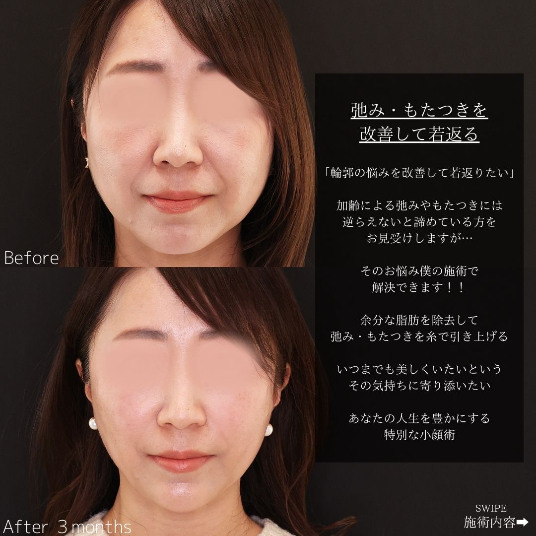 TAC式 ツヤ肌コラーゲンリフト®/ジョールファット除去/眉間のしわ取りボトックス注射の症例写真 施術前後 