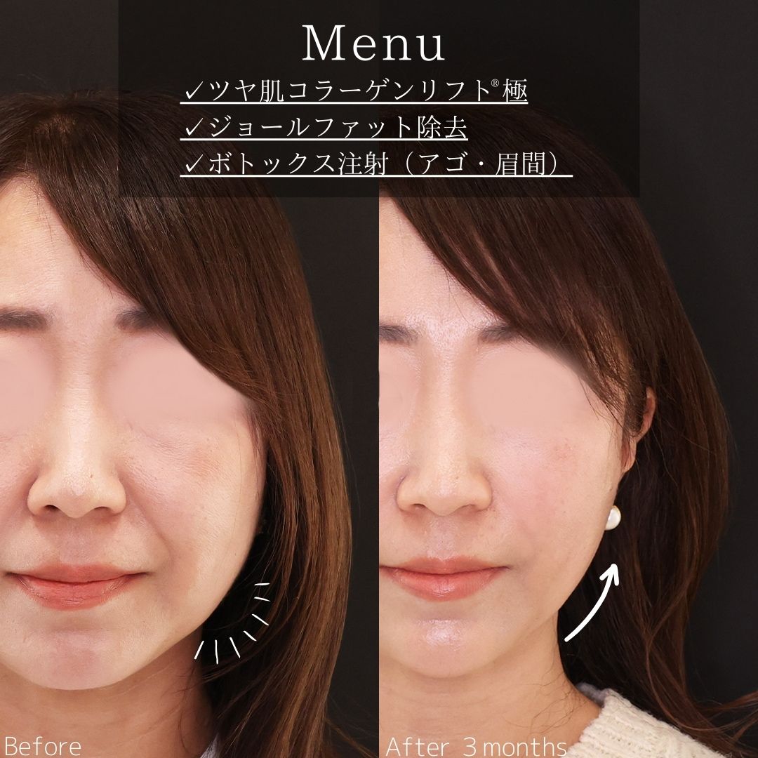 TAC式 ツヤ肌コラーゲンリフト®/ジョールファット除去/眉間のしわ取りボトックス注射の症例写真 施術前後 