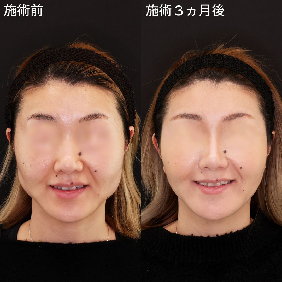 ブルドッグ顔改善！絶人級小顔術【小顔複合術】