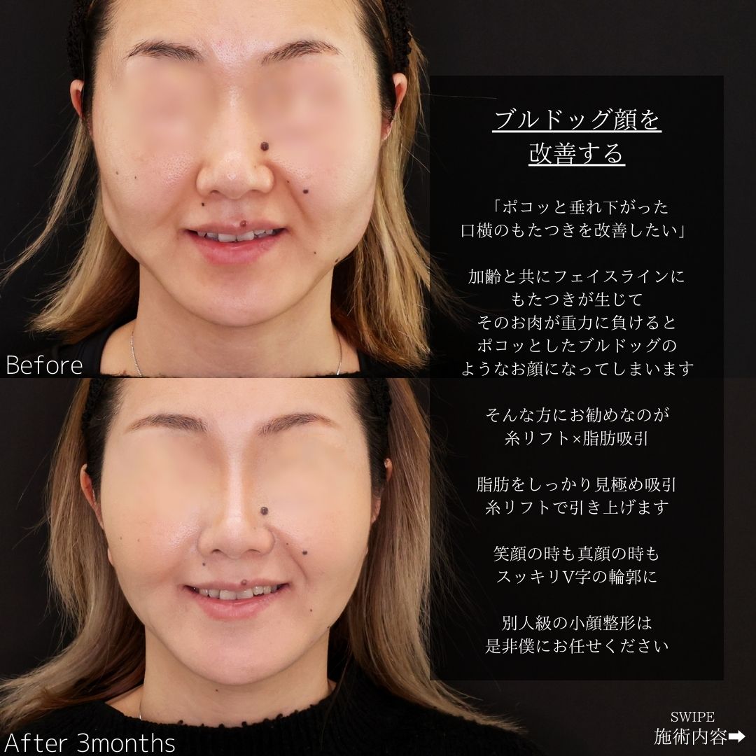 TAC式 ツヤ肌コラーゲンリフト®/ジョールファット除去/バッカルファット除去の症例写真 施術前後 