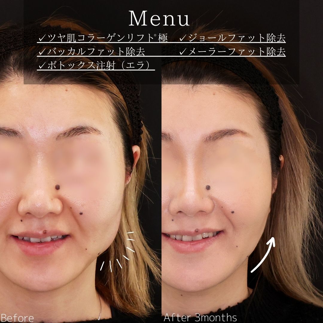 TAC式 ツヤ肌コラーゲンリフト®/ジョールファット除去/バッカルファット除去の症例写真 施術前後 