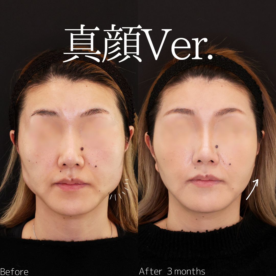 TAC式 ツヤ肌コラーゲンリフト®/ジョールファット除去/バッカルファット除去の症例写真 施術前後 