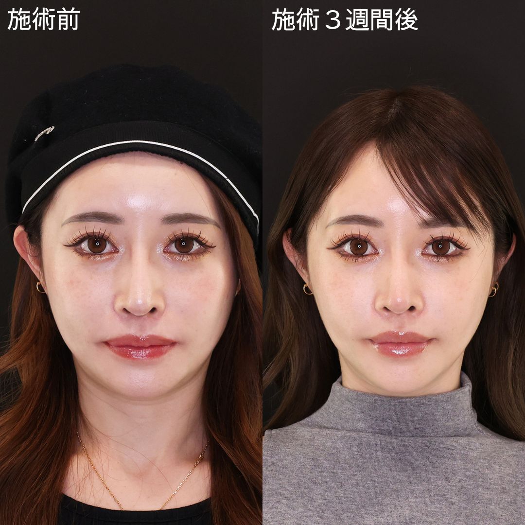 自分史上1番の小顔に！女優級小顔術【糸リフト】