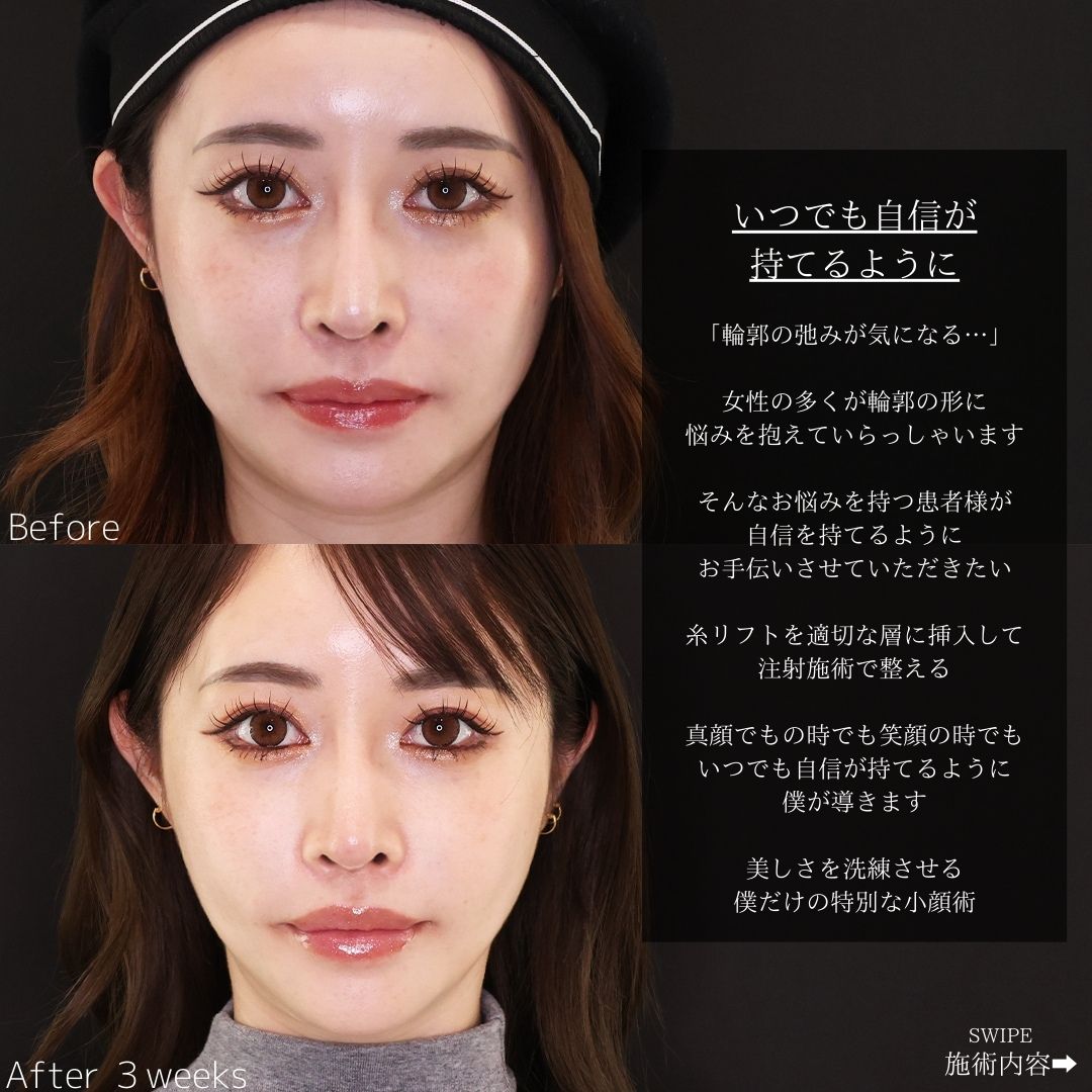 TAC式 ツヤ肌コラーゲンリフト®/ほうれい線のヒアルロン酸注射/眉間のしわ取りボトックス注射の症例写真 施術前後 