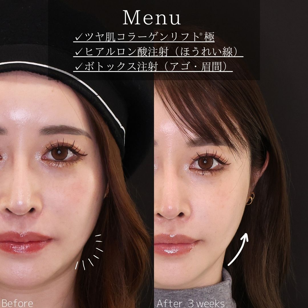 TAC式 ツヤ肌コラーゲンリフト®/ほうれい線のヒアルロン酸注射/眉間のしわ取りボトックス注射の症例写真 施術前後 