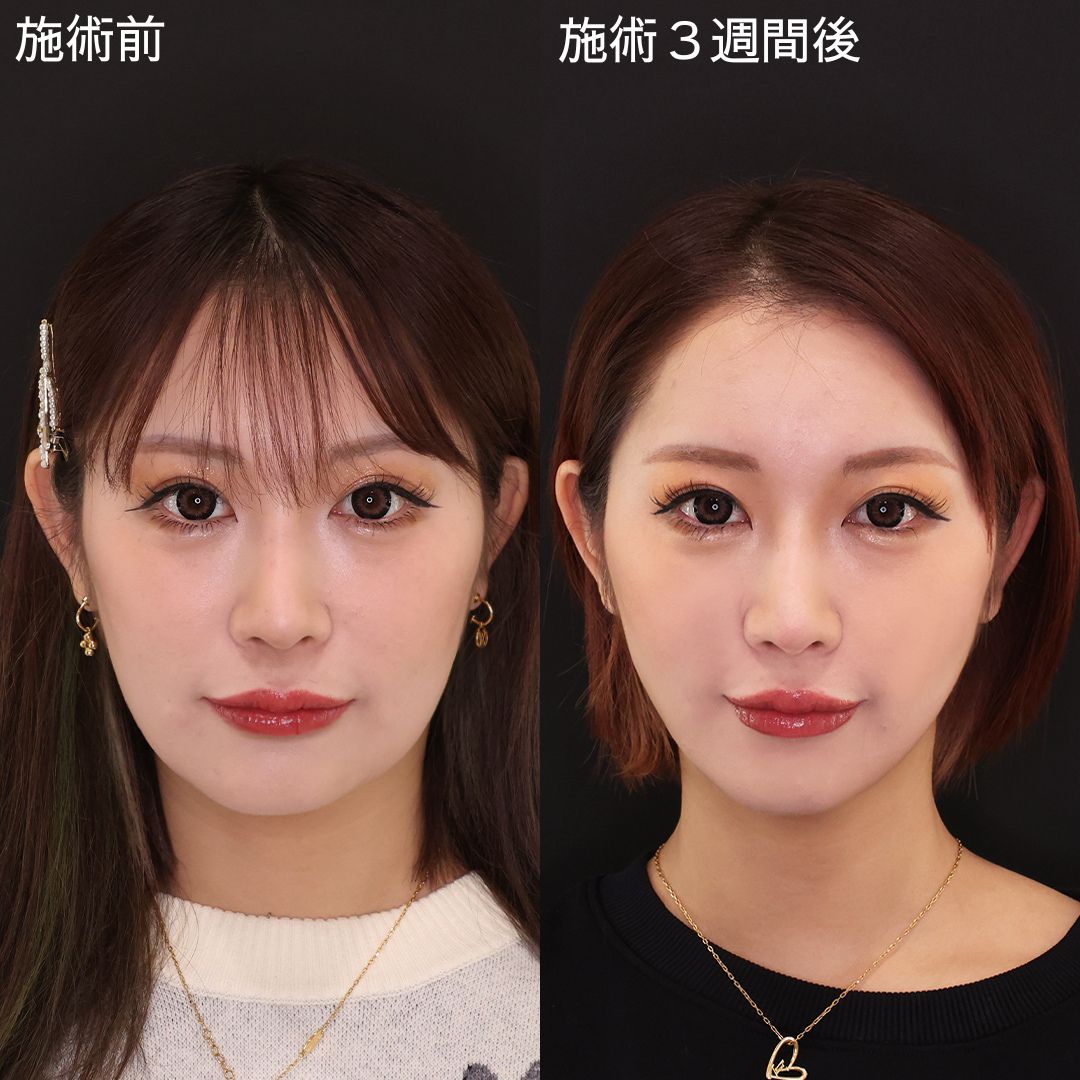 たった15分で垢抜ける 美を極める小顔術【糸リフト】