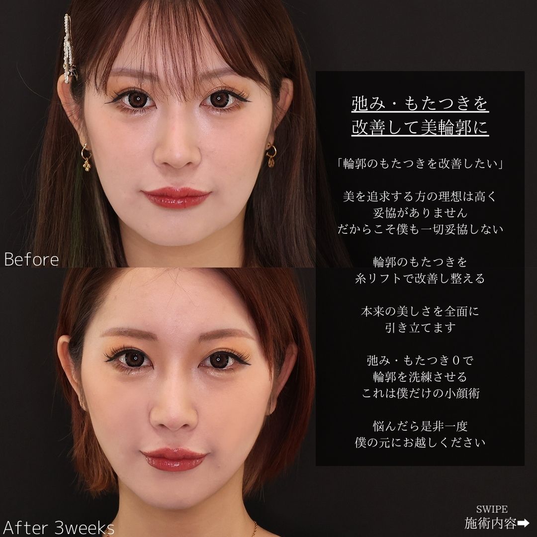 TAC式 ツヤ肌コラーゲンリフト®/ほうれい線のヒアルロン酸注射の症例写真 施術前後 