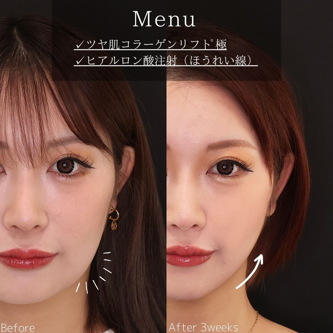 TAC式 ツヤ肌コラーゲンリフト®/ほうれい線のヒアルロン酸注射の症例写真 施術前後 
