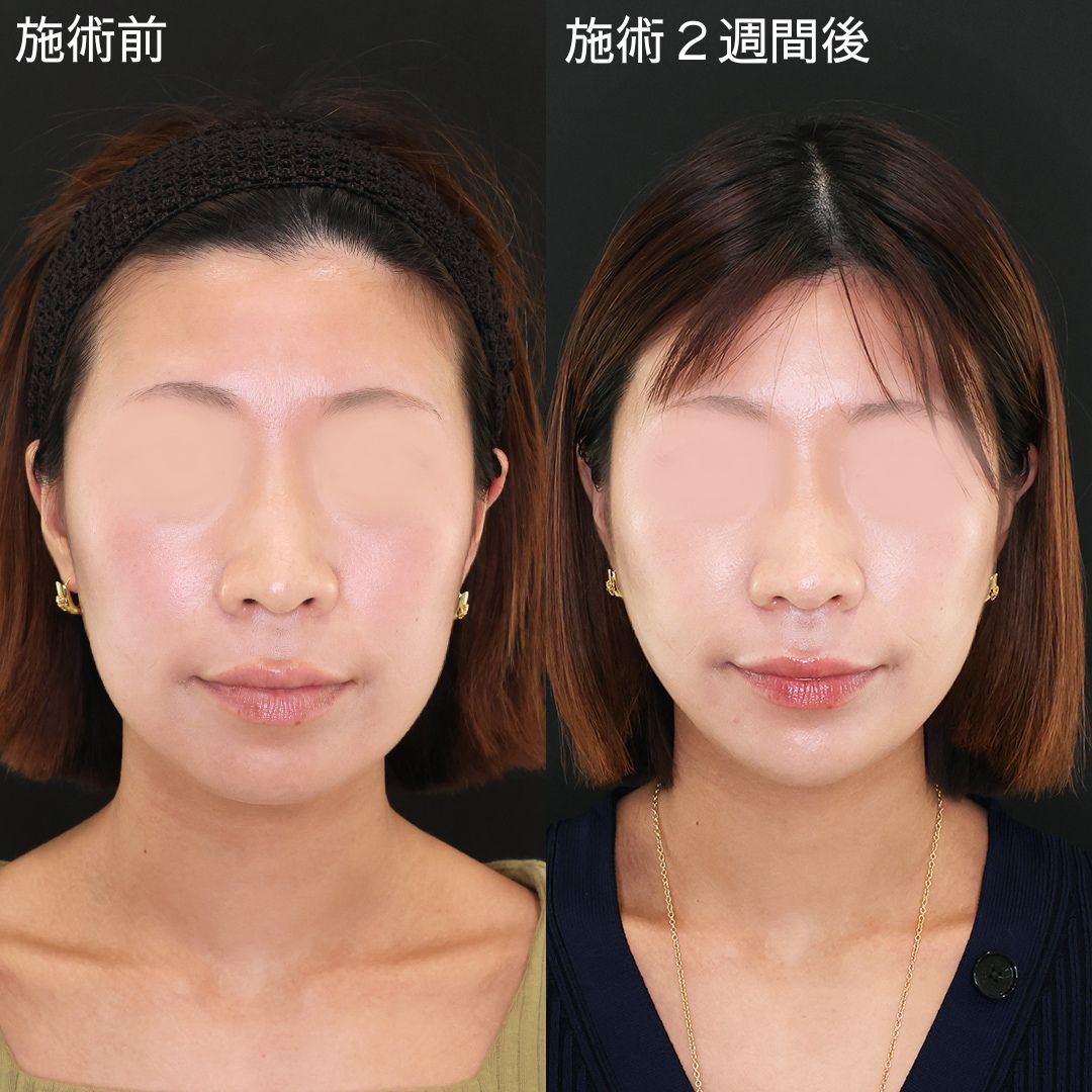 Dr.石橋の面長改善小顔術！【糸リフト】