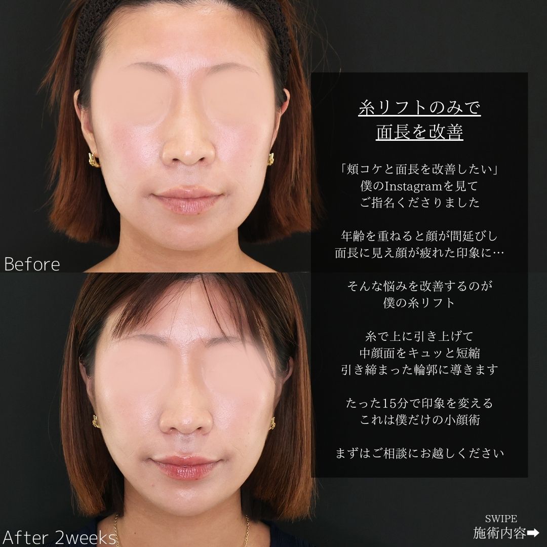 TAC式 ツヤ肌コラーゲンリフト®/顎のヒアルロン酸注射/おでこボトックス注射の症例写真 施術前後