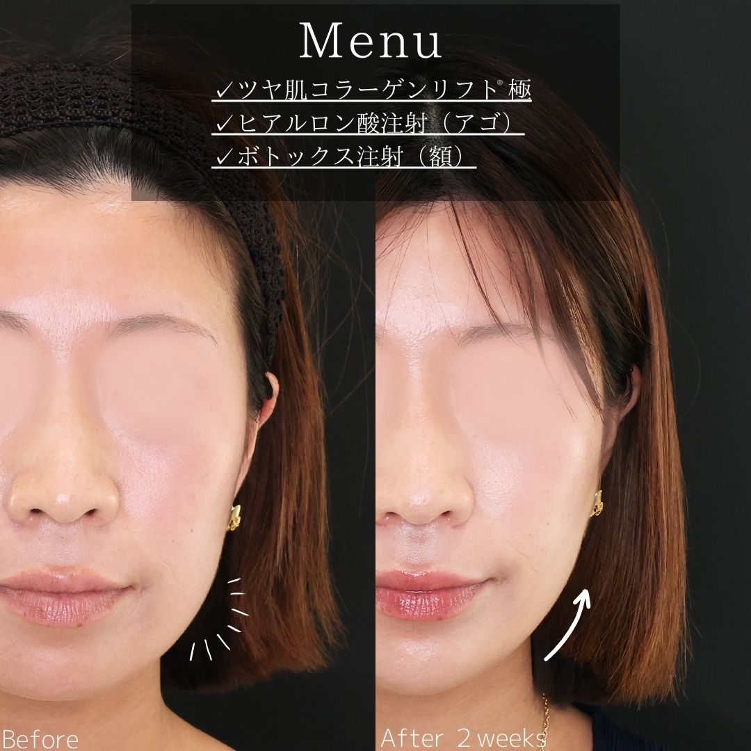 TAC式 ツヤ肌コラーゲンリフト®/顎のヒアルロン酸注射/おでこボトックス注射の症例写真 施術前後