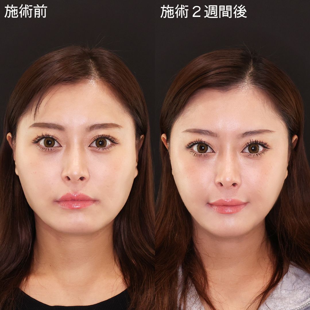 糸リフトで理想の輪郭に！女優級小顔術【糸リフト】