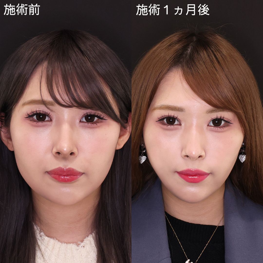 お顔のボリュームダウンで垢抜ける【糸リフト】