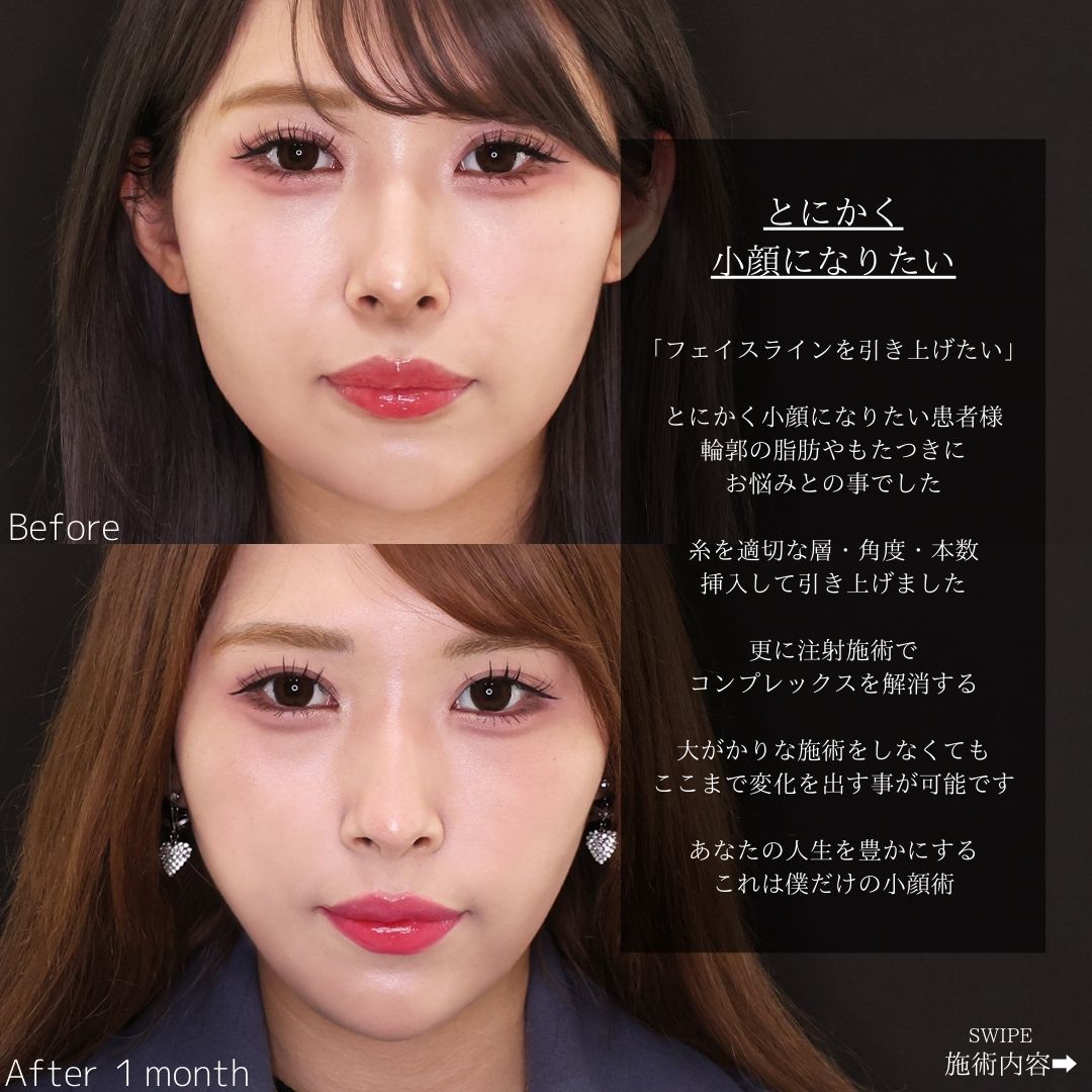 TAC式 ツヤ肌コラーゲンリフト®/エラボトックス注射/ほうれい線のヒアルロン酸注射の症例写真 施術前後 