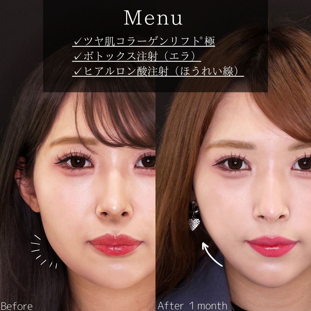 TAC式 ツヤ肌コラーゲンリフト®/エラボトックス注射/ほうれい線のヒアルロン酸注射の症例写真 施術前後 