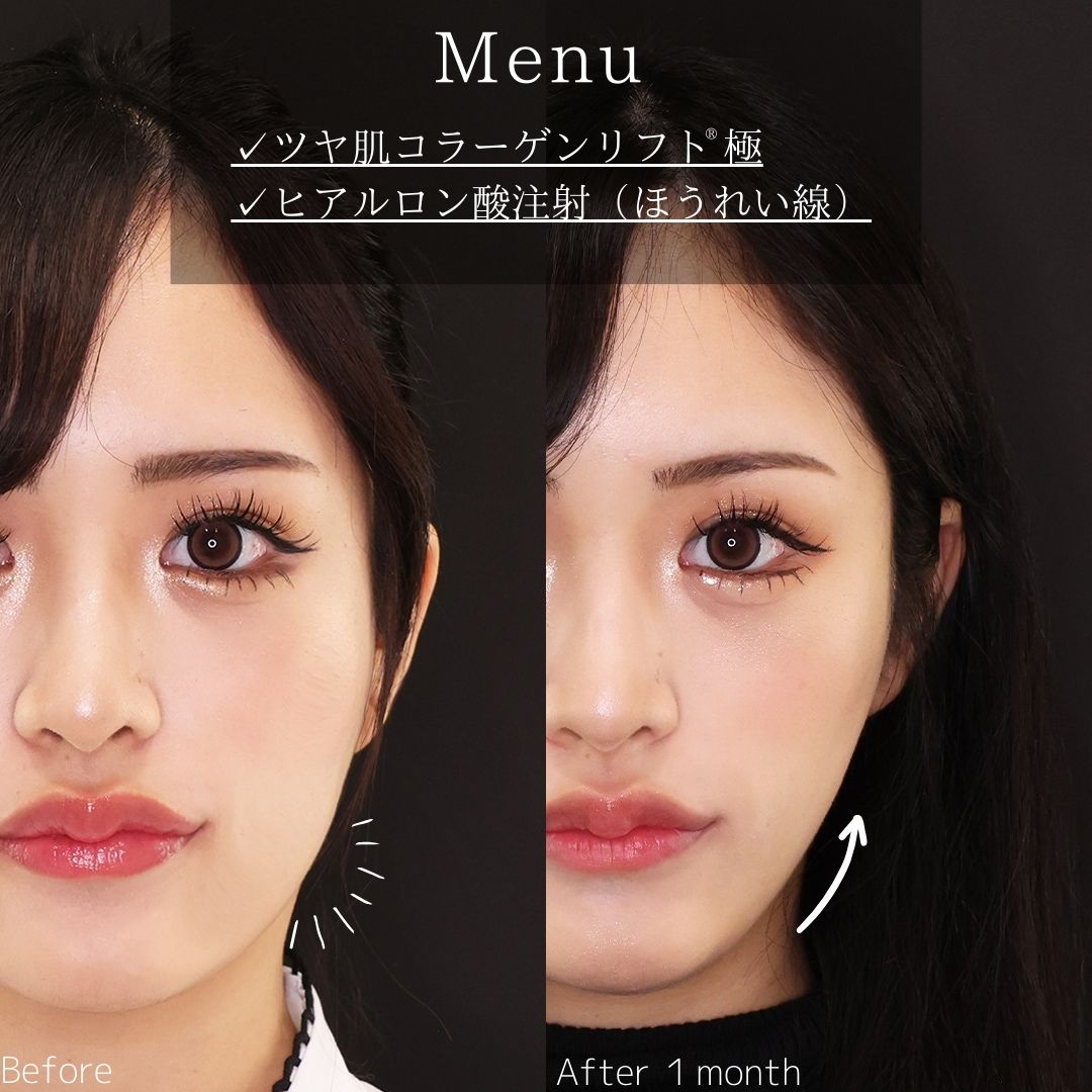 TAC式 ツヤ肌コラーゲンリフト®/ほうれい線のヒアルロン酸注射の症例写真 施術前後 