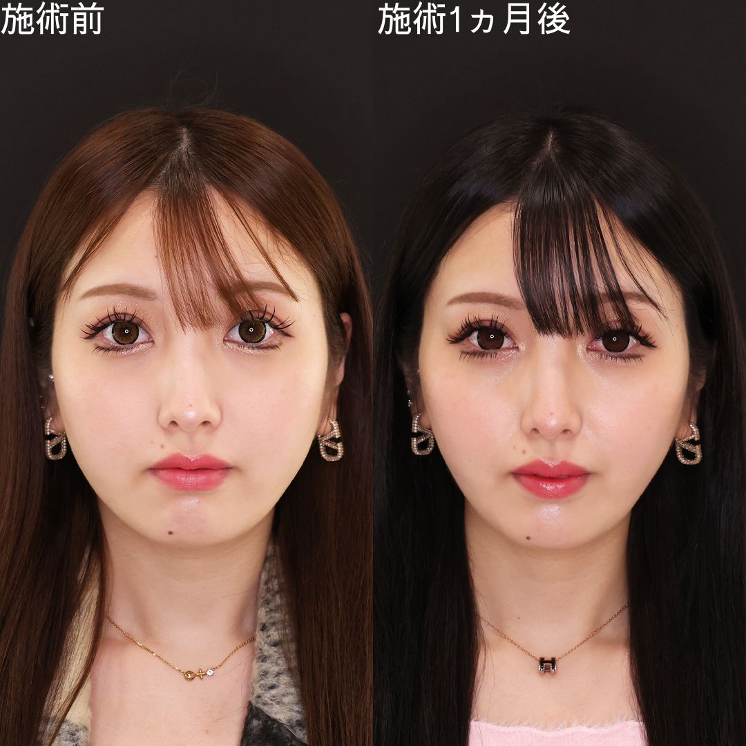 お悩みのもたつきを改善！アプリ級小顔術【小顔複合術】