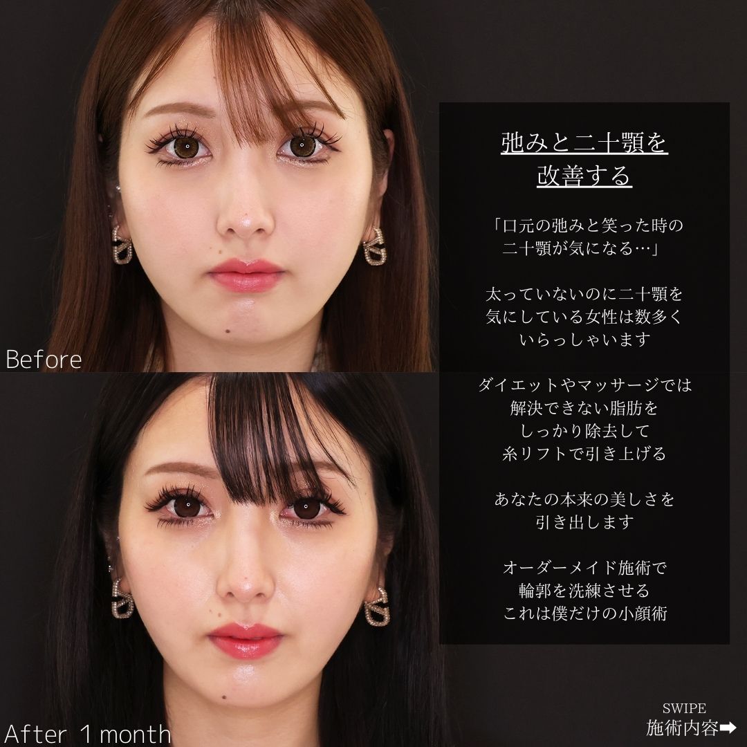 TAC式 ツヤ肌コラーゲンリフト®/顎下の脂肪吸引/Lラインファット除去（エラ下脂肪除去）の症例写真 施術前後 