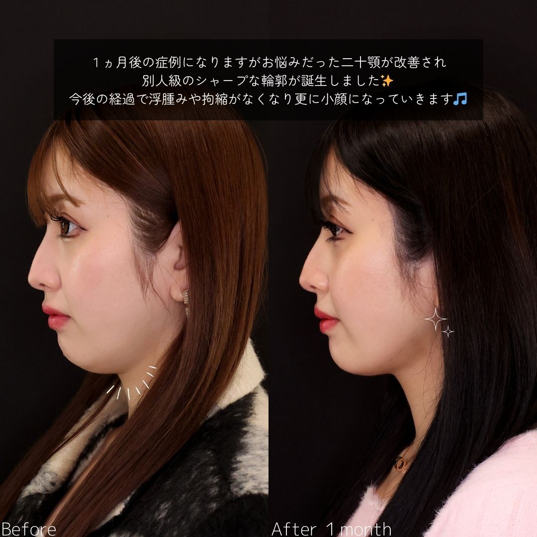 TAC式 ツヤ肌コラーゲンリフト®/顎下の脂肪吸引/Lラインファット除去（エラ下脂肪除去）の症例写真 施術前後 