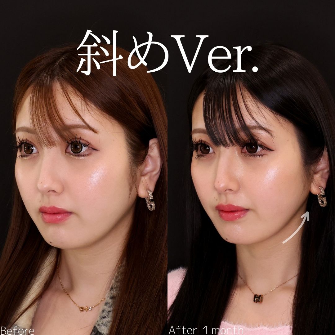 TAC式 ツヤ肌コラーゲンリフト®/顎下の脂肪吸引/Lラインファット除去（エラ下脂肪除去）の症例写真 施術前後 