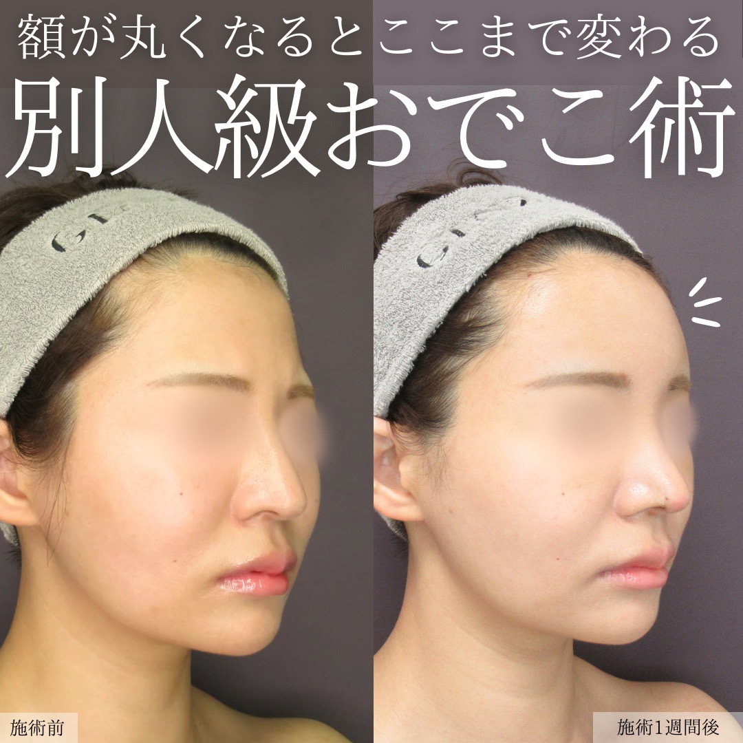 顔の脂肪注入(コンデンスリッチフェイス)の症例写真 施術前後 