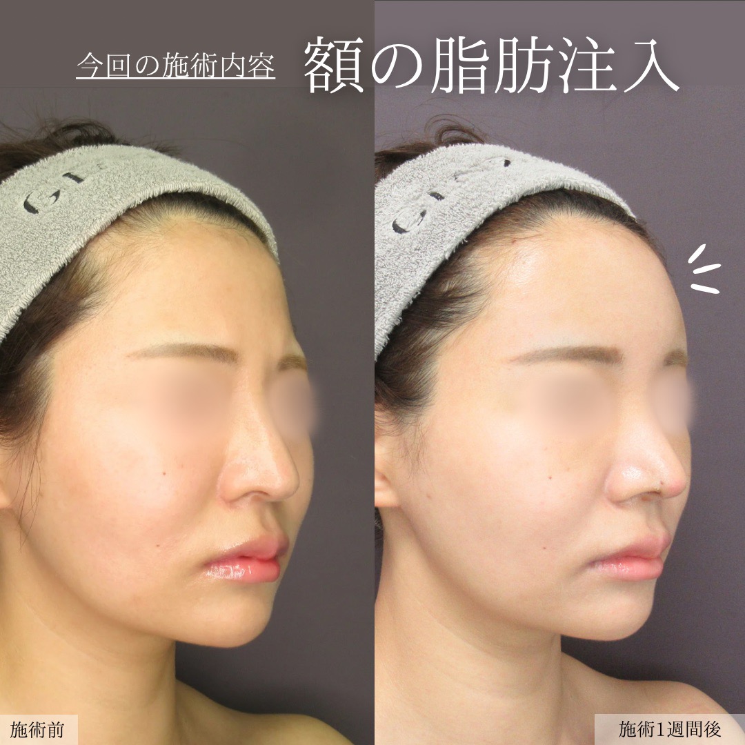 顔の脂肪注入(コンデンスリッチフェイス)の症例写真 施術前後 