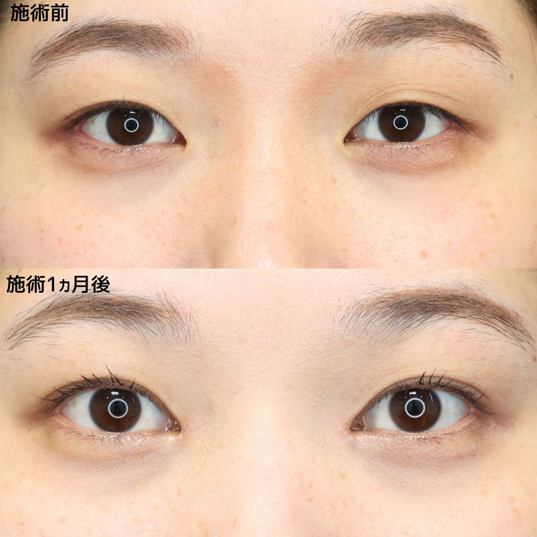 二重埋没法/目頭切開術の症例写真 施術前後