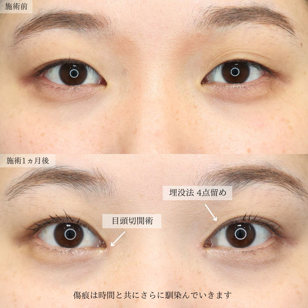 二重埋没法/目頭切開術の症例写真 施術前後