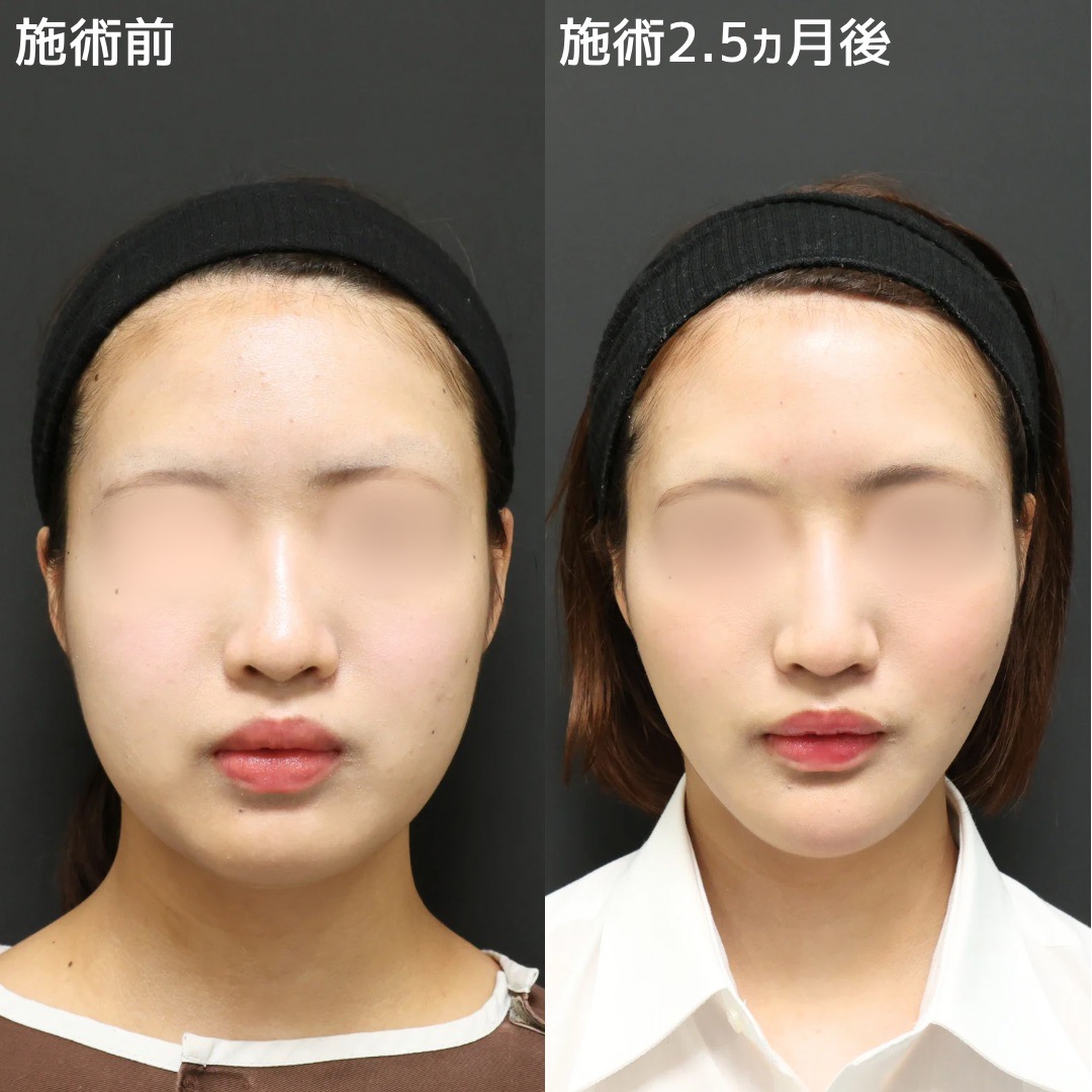 《小顔整形》他院で満足いかなかった方もお任せ下さい