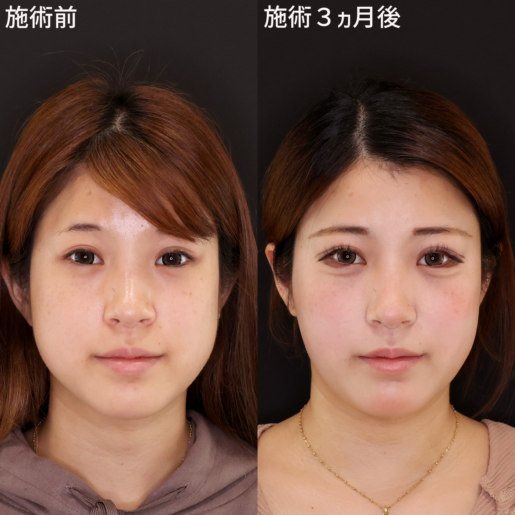 シャープな輪郭を形成して垢抜ける！Dr.もりもりの小顔術【糸リフト×脂肪吸引】