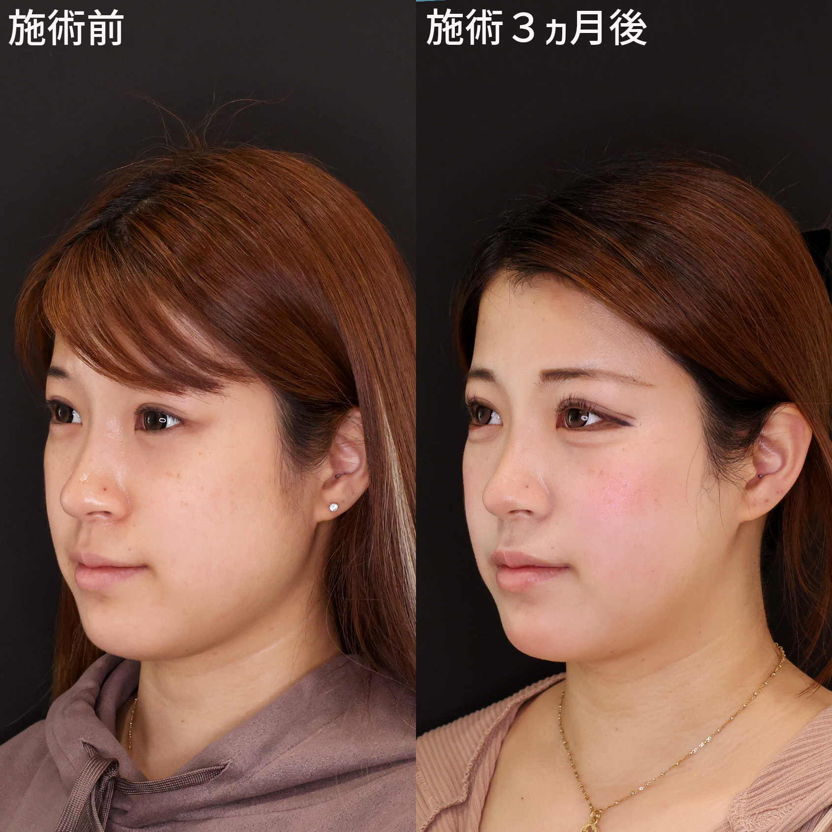 TAC式 ツヤ肌コラーゲンリフト®/ジョールファット除去/顔の脂肪吸引の症例写真 施術前後 